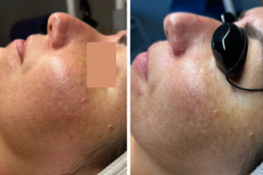 REAL CLIENT RESULTS - GREEN PEEL SPICULE FACIAL TREATMENT AT SKIN AND TONIC