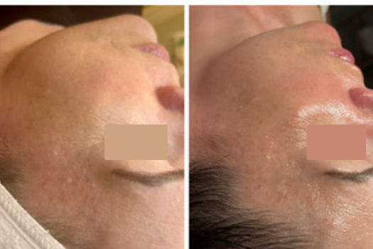 REAL FEMALE CLIENT BEFORE AND AFTER SPICULE TREATMENT AT SKIN AND TONIC