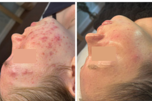 REAL FEMALE CLIENT OF SKIN AND TONIC BEFORE AND AFTER PHOTOS OF FACE REALITY BOOTCAMP TREATMENTS