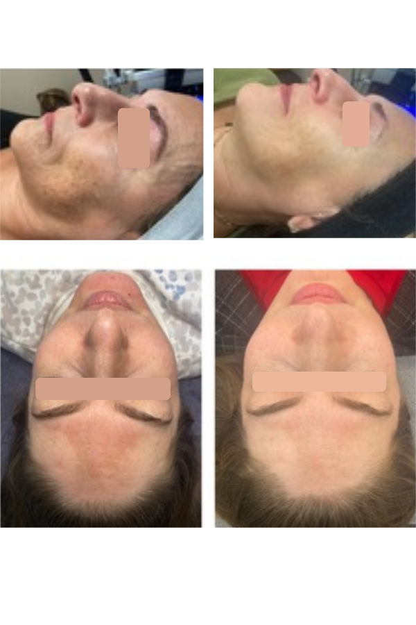 REAL FEMALE CLIENTS BEFORE AND AFTER CUSTOM CHEMICAL PEEL TREATMENT WITH PHYLLIS