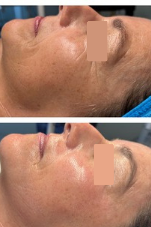 REAL SKIN AND TONIC CLIENT-BEFORE AND AFTER PHOTOS OF NEEDLE FREE FILLER KOREAN SPECIALTY FACIAL TREATMENT