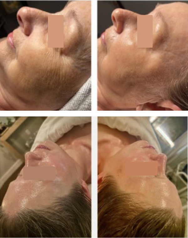 TWO REAL FEMALE CLIENTS BEFORE AND AFTER PHOTOS - TREATMENT BY PHYLLS AT SKIN AND TONIC
