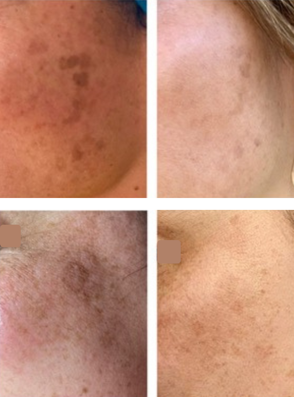 TWO WOMEN WITH SUN DAMAGE SPOTS ON THEIR CHEEKS-BEFORE AND AFTER TREATMENT AT SKIN AND TONIC WITH PHYLLIS