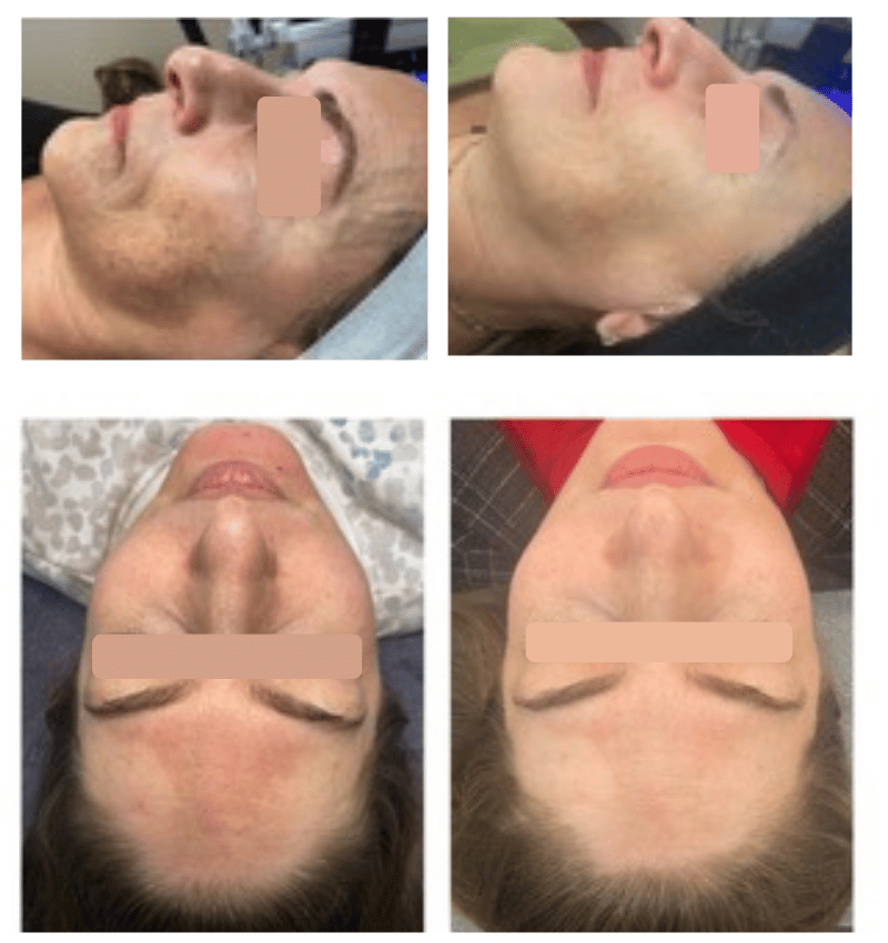 chemical peel before and after - woman with dark spots on her cheeks